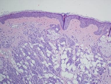 Intradermal melanocytic nevus with adipocyte metap