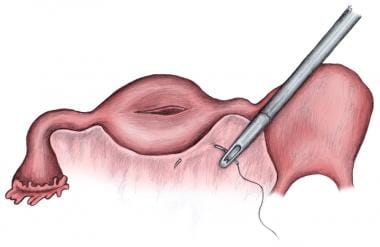 Salpingectomy technique. Pedicle is cut free and l