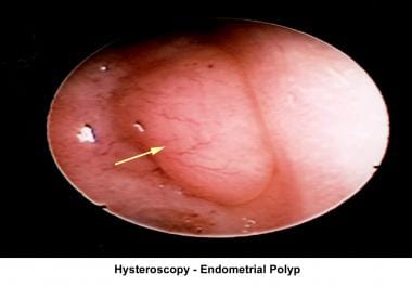 Infertility. Hysteroscopy - Endometrial polyp. Ima