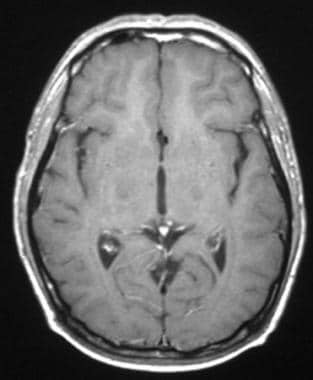 Pineal germinoma in a 30-year-old man. After radia