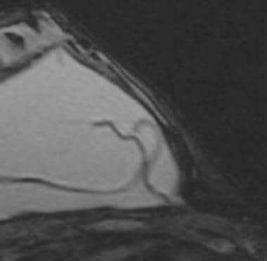 Magnetic resonance image shows the keyhole, or inv