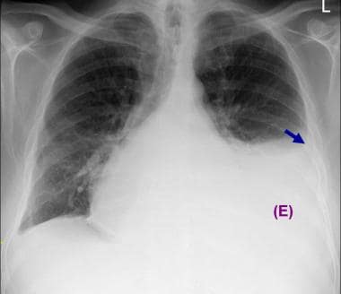 Posteroanterior chest radiograph in a 50-year-old 