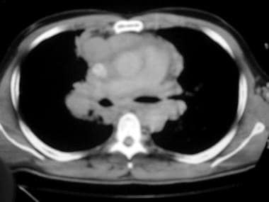 A CT scan showing bulk disease. 