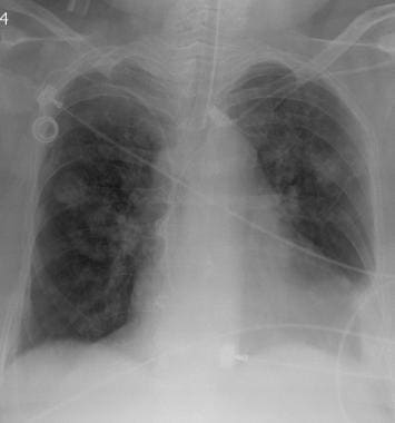 Chest radiograph in a 58-year-old man with squamou