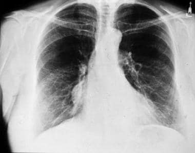 Low-lying thymoma. Plain chest radiograph shows a 
