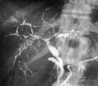 sclerosing cholangitis