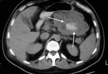 Gastrointestinal stromal tumor (GIST). CT scan obt