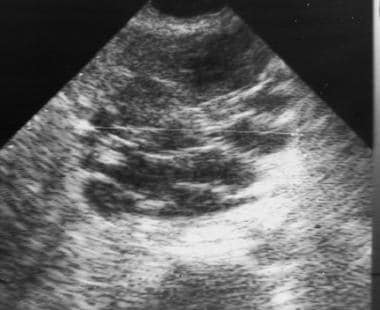 Sonogram of serous cystadenoma. The large mass in 