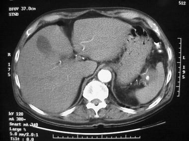CT scan of a pancreatic pseudocyst emanating from 