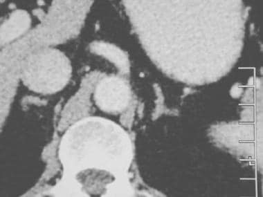 Contrast-enhanced axial CT scan of a normal left a
