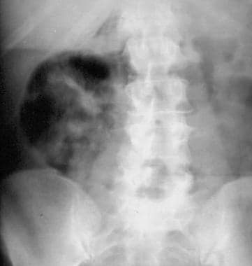 pyelonephritis x ray