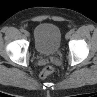 Nonenhanced CT image of the pelvis shows dilatatio