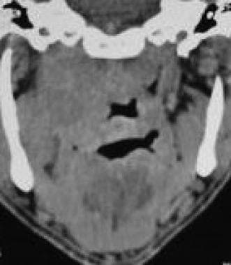 Nonenhanced CT scan (coronal view) shows thickenin