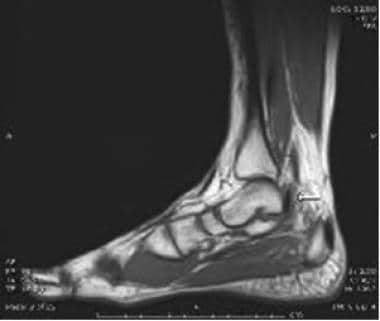 Sagittal T1-weighted image of the ankle shows the 