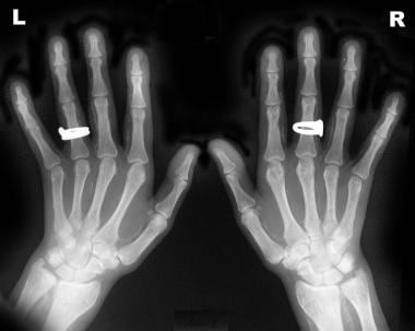 Radiograph of both hands of a 36-year-old woman re