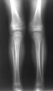 Hereditary multiple exostoses with spinal cord compression.