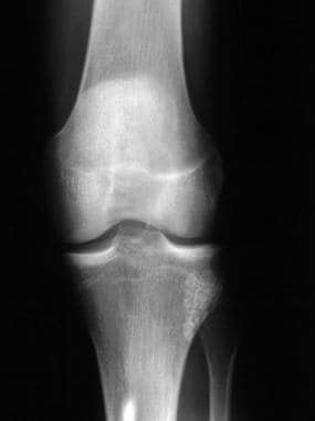 Frontal radiograph of the knee shows multiple calc
