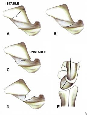 Images illustrate fracture stability. Nondisplaced