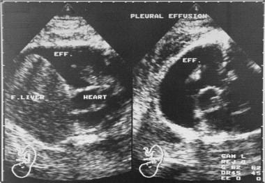 fetal pleural effusion ultrasound