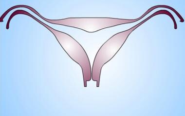 Uterus, müllerian duct abnormalities. Arcuate uter