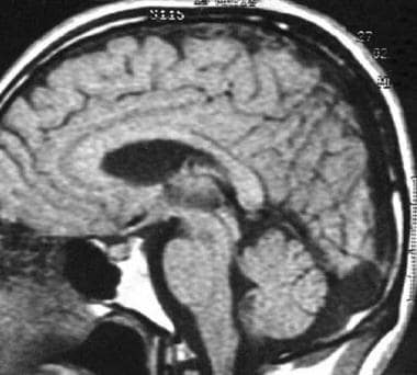 This sagittal T1-weighted MRI shows a large retroc