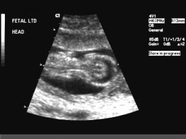 Ultrasonogram obtained at 14 weeks' gestation in a