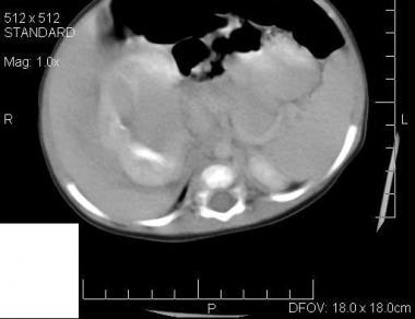 Axial image through the kidneys demonstrates a mas