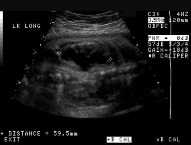 产前左肾纵向超声图。