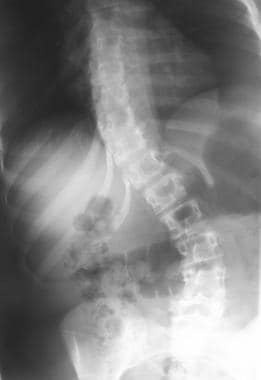 Right lateral bending view of a patient with scoli