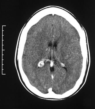 Axial contrast-enhanced CT scan through the occipi
