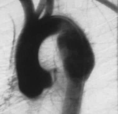 Aorta, trauma. Image shows a chronic isthmus pseud