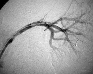 Control angiogram (same patient as in the previous