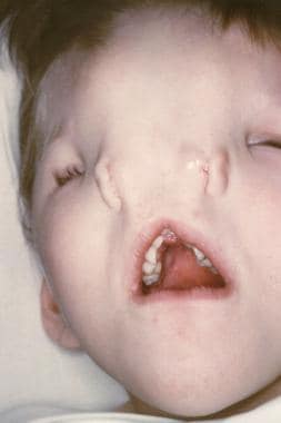 The photograph shows a child with median nasal cle