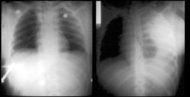 Left: Plain chest radiographs depicts a widened me