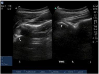 Ultrasound image of normal (right) and anteriorly 