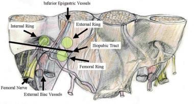 Inguinal anatomy from laparoscopic viewpoint. 