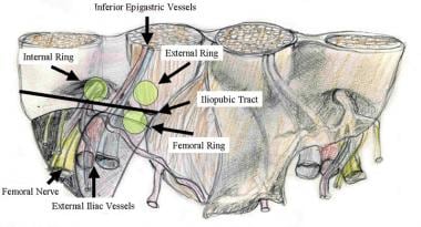 Hernia Reduction: Background, Indications, Contraindications