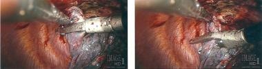 Video-assisted thoracoscopic surgery (VATS). Thora