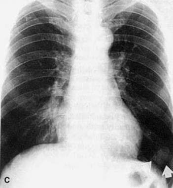 Follow-up chest radiograph of a 54-year-old man sh