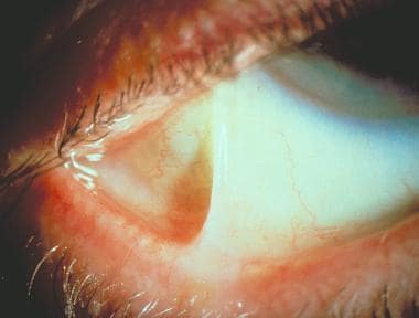 Ocular manifestations of cicatricial pemphigoid (m