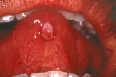 Mucocele on the midline ventral surface of the ton
