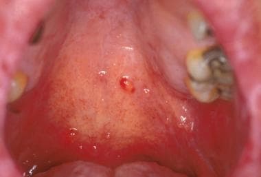Multiple mucoceles on the hard palate. 