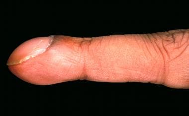 Clubbing Of The Nails Clinical Presentation History Physical Examination Complications