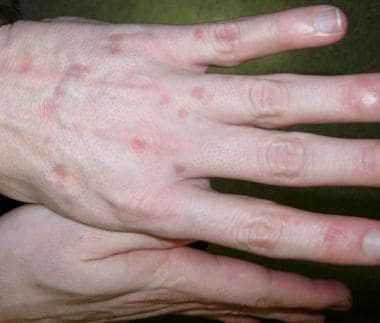 Verrucous or seborrheic keratosis–like lesions of 