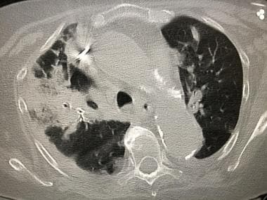 CT scan of an 82-year-old woman with proven SARS-c