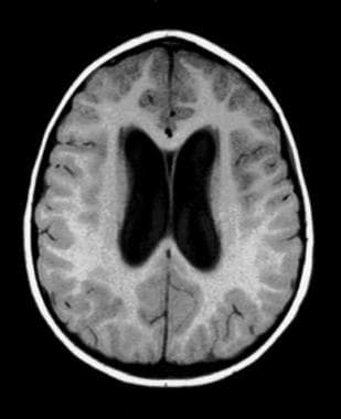 Noncommunicating obstructive hydrocephalus caused 