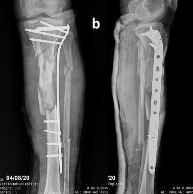 Diaphyseal tibial fracture. Postoperative anteropo