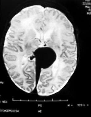 Cerebral MRI showing large flow void in the centra