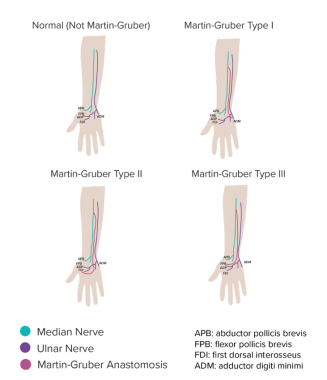 Normal median and ulnar patterns are compared with
