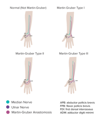 Orthobullets - This illustration shows the common potential sites of ulnar  nerve entrapment around the elbow.